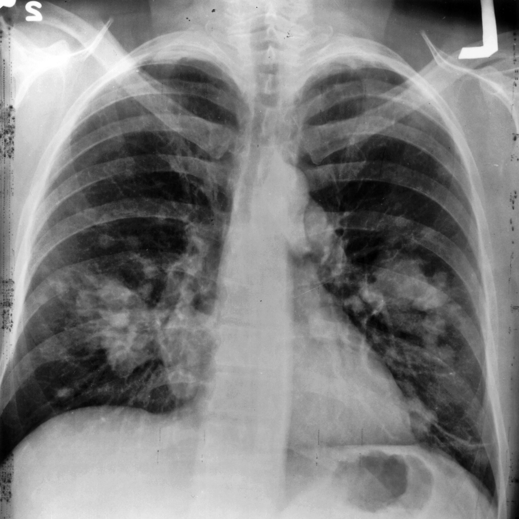 A chest X-ray showing lung cancer, from the National Cancer Institute's Visuals Online archive